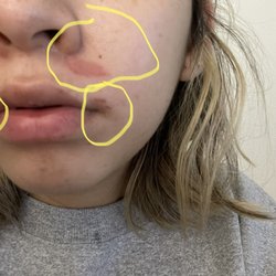Blink Browz Art - Damaged skin by wax