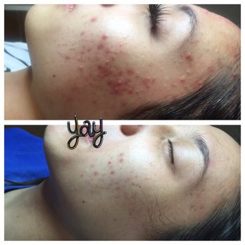 Skin by Jane Mann - I normally don't post photos like this but I had really bad acne due to my shampoos and detergents, etc. but in 3 months.. GONE - Skin Care Near Me - Las Vegas, Nevada Skin by Jane Mann - I normally don't post photos like this but I had really bad acne due to my shampoos and detergents, etc. but in 3 months.. GONE - Skin Care Near Me - Las Vegas, Nevada