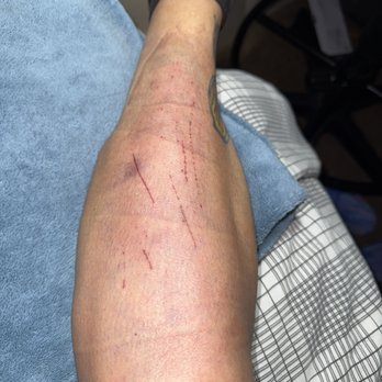Malta Med Emergent Care - Pic from a couple days after. Still can't bear much weight or move toes/foot w/o severe pain. NSAIDs don't touch it. - Urgent Care Near Me - Malta, New York