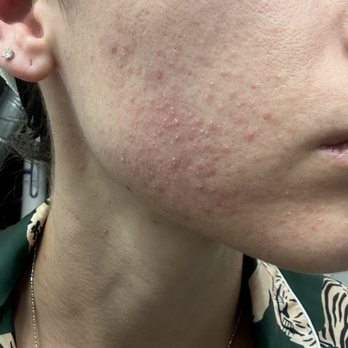 PENZONE Salon + Spa - Dublin - Fungal acne 2 days after event due to lack of cleanliness. - Hair Salons Near Me - Dublin, Ohio