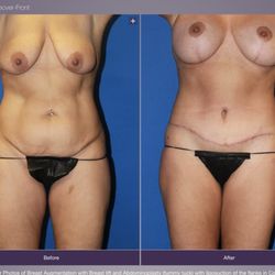 Institute Of Plastic Surgery - Before and After Photos of Breast Augmentation with Breast lift and Abdominoplasty with liposuction of the flanks in Colorado Springs, CO