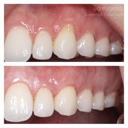 Eugenia Prokopets, DDS MSD - Connective Tissue Graft to treat root exposure and anesthetic appearance