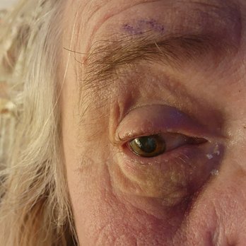 Humboldt Medical Eye Associates - Hurts like heck. Why does it hurt so bad if it doesn't work? - Optometrists Near Me - Eureka, California Humboldt Medical Eye Associates - Hurts like heck. Why does it hurt so bad if it doesn't work? - Optometrists Near Me - Eureka, California