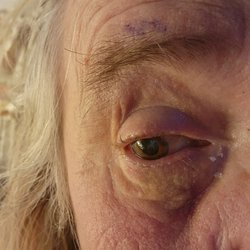 Humboldt Medical Eye Associates - Hurts like heck. Why does it hurt so bad if it doesn't work?
