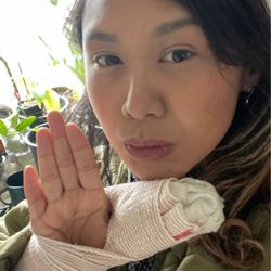 Nicole Nemeth, MD - Healing with my splint