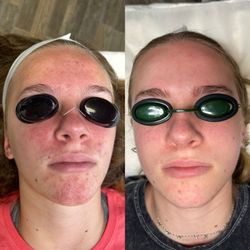 Face Five Acne Clinic