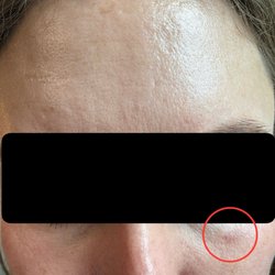 Revive Med Spa - Carmel Valley - Bruising three weeks after treatment.