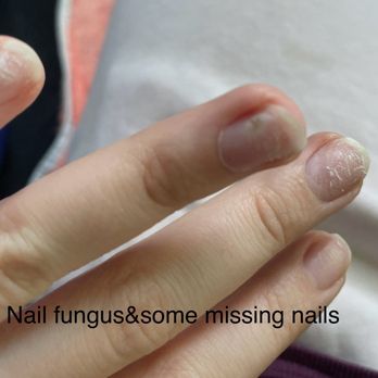 Nails & Spa - Damaged nails and fungus from ANC popped off 6 nails total. never seen anc pop off clean like this? Train or Bad product? - Nail Salons Near Me - Glenmont, New York Nails & Spa - Damaged nails and fungus from ANC popped off 6 nails total. never seen anc pop off clean like this? Train or Bad product? - Nail Salons Near Me - Glenmont, New York