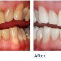 David W Hyten, DMD - This photo is from the KOR whitening website and typical or results with two weeks of KOR whitening.