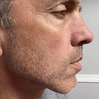 AC Aesthetics - Laser hair removal on a client's cheeks! - Laser Hair Removal Near Me - Providence, Rhode Island