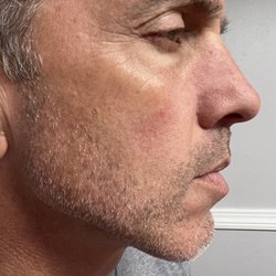 AC Aesthetics - Laser hair removal on a client's cheeks!
