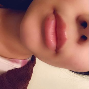 Skin Theory - Lips - Laser Hair Removal Near Me - Corona, California Skin Theory - Lips - Laser Hair Removal Near Me - Corona, California