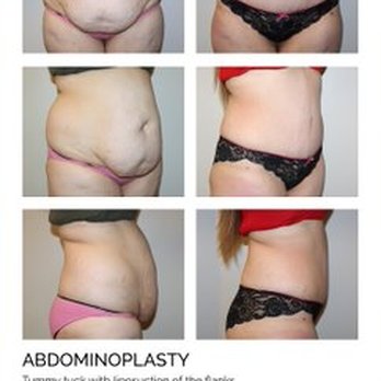 Zarrabi Plastic Surgery - Abdominoplasty - Cosmetic Surgeons Near Me - Beverly Hills, California Zarrabi Plastic Surgery - Abdominoplasty - Cosmetic Surgeons Near Me - Beverly Hills, California