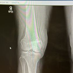 Dr.David Craig Angelillo, DO- Northwell Health - Knee repair.