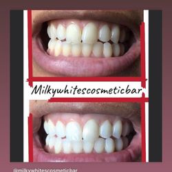 Milky Whites Cosmetic Bar - 30 minute express treatment