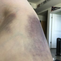 day after... "Technicians: do not know how to insert needles" Horrible.. Too much in a hurry and not paying enough attention to care day after... "Technicians: do not know how to insert needles" Horrible.. Too much in a hurry and not paying enough attention to care