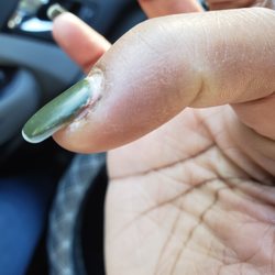 Angel Hair & Nail - Close up of area infected and skin dry from being stretched after swelling..