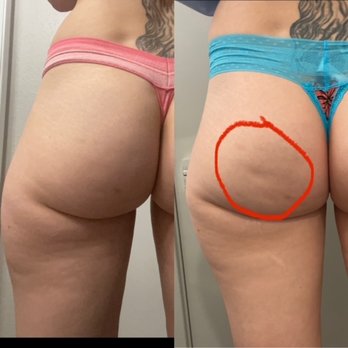 AK Body - Cellulite reducer, skin tightening - Skin Care Near Me - Las Vegas, Nevada AK Body - Cellulite reducer, skin tightening - Skin Care Near Me - Las Vegas, Nevada