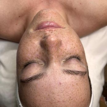 Pura Vida Bella - Before - Skin Care Near Me - Sacramento, California Pura Vida Bella - Before - Skin Care Near Me - Sacramento, California