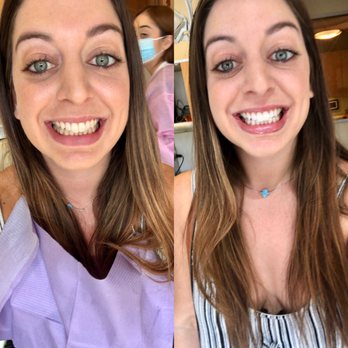 The Downey Dentist - Left: Before, Right: After NO FILTER - General Dentistry Near Me - Downey, California