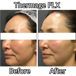 Bloom Medical Aesthetics - Thermage  Contact us for more information