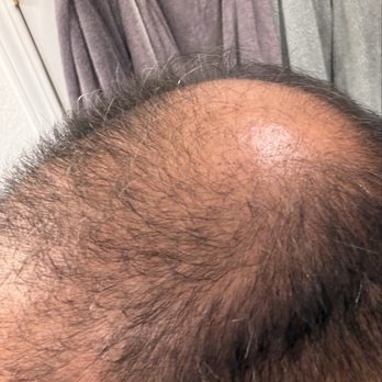 TJ Hair System - Before my procedure - Hair Loss Centers Near Me - Tijuana, BCN TJ Hair System - Before my procedure - Hair Loss Centers Near Me - Tijuana, BCN