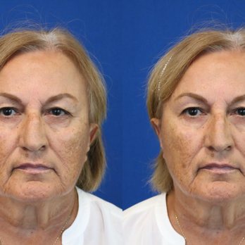 Christian Paquet, MD - Before surgery - Cosmetic Surgeons Near Me - Phoenix, Arizona Christian Paquet, MD - Before surgery - Cosmetic Surgeons Near Me - Phoenix, Arizona
