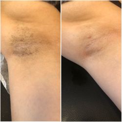 Wax Haven - An underarm wax before/after