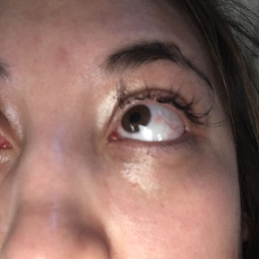 Skin Secrets & Threading - Infected, irritated eyelid. I don't have any more of my own lashes left - Threading Services Near Me - Northglenn, Colorado