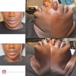 The Peach Bar - Jawline contouring double chin reduction