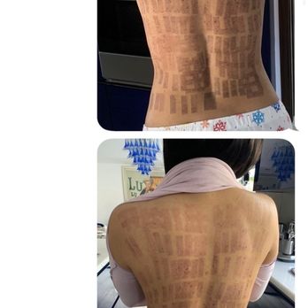 VIOR Life & Aesthetics - Completely burn - Medical Spas Near Me - Miami, Florida VIOR Life & Aesthetics - Completely burn - Medical Spas Near Me - Miami, Florida