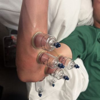Sports Specific Rehab - Elbow cupping - Physical Therapy Near Me - Corona, California Sports Specific Rehab - Elbow cupping - Physical Therapy Near Me - Corona, California