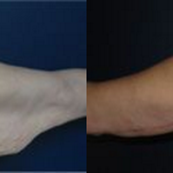Westfield Plastic Surgery Center - Arm Lift - Cosmetic Surgeons Near Me - Omaha, Nebraska Westfield Plastic Surgery Center - Arm Lift - Cosmetic Surgeons Near Me - Omaha, Nebraska