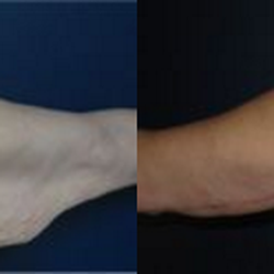 Westfield Plastic Surgery Center - Arm Lift