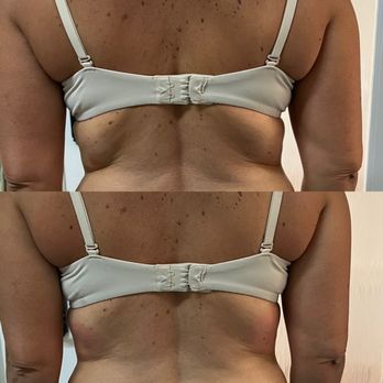 CryoSculpt Carolina - Before (top) & After 1 shape treatment - Body Contouring Near Me - Charlotte, North Carolina CryoSculpt Carolina - Before (top) & After 1 shape treatment - Body Contouring Near Me - Charlotte, North Carolina