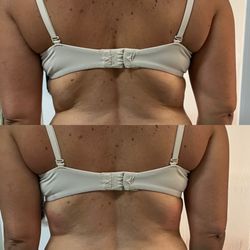 CryoSculpt Carolina - Before (top) & After 1 shape treatment