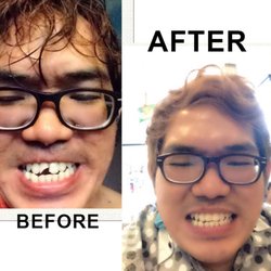Precilyn B Silvestre, DDS - My Partial Dentures last summer too ridiculous! Im glad it was fixed beautifully!