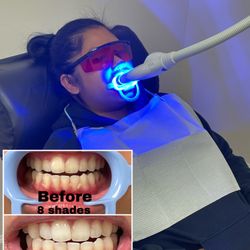 Smile Again Teeth Whitening