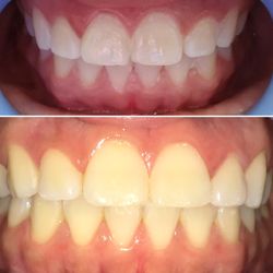 Happy General Whitening - Real customer results