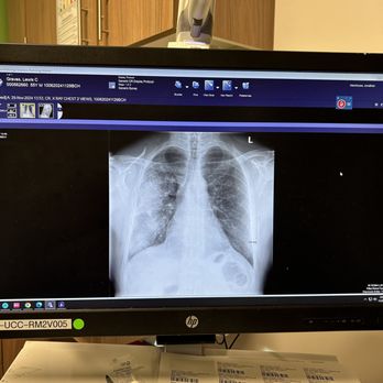 Icelandic Fitness - What pneumonia looks like in a chest x-ray. - Trainers Near Me - Denver, Colorado Icelandic Fitness - What pneumonia looks like in a chest x-ray. - Trainers Near Me - Denver, Colorado