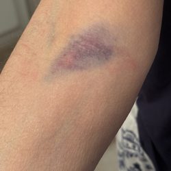 Quest Diagnostics - This is what happens when a lab tech doesn't listen and a pressure dressing/wrap is not used.