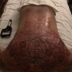 Jing Massage - Cupping preformed by Kim