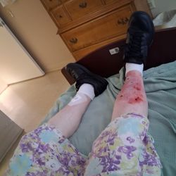 The Westchester House - My leg living at Westchester House nursing 6