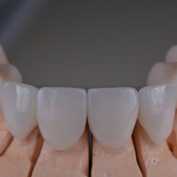 Marlton Dental Care - High end porcelain crowns - General Dentistry Near Me - Marlton, New Jersey Marlton Dental Care - High end porcelain crowns - General Dentistry Near Me - Marlton, New Jersey