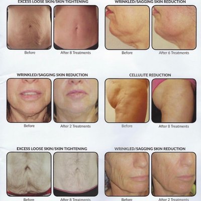 New You Laser by null