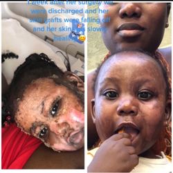 Grossman Burn Center - My baby after Surgery