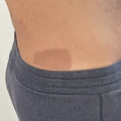 Aqua Spa - Freeze Burn Mark Photo on April 4th