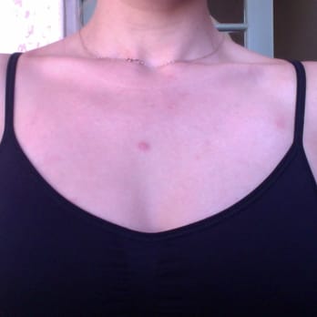 dr LASER - $1,500 & 5 months trying to get rid of scar with them only for me to find out THEY KNOWINGLY GAVE ME WRONG TREATMENT just to make sale! - Medical Spas Near Me - West Hollywood, California dr LASER - $1,500 & 5 months trying to get rid of scar with them only for me to find out THEY KNOWINGLY GAVE ME WRONG TREATMENT just to make sale! - Medical Spas Near Me - West Hollywood, California