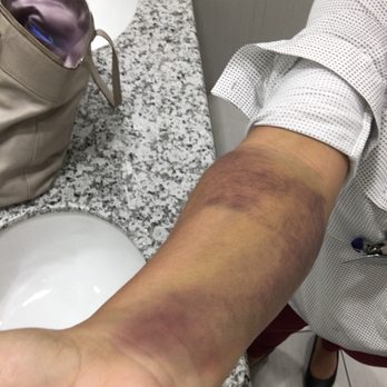 Gulf Coast Blood - This is day 6!It's painful to rotate, bend and the entire area is tender and itches! I can't lift my baby with my right arm. - Blood & Plasma Donation Centers Near Me - Katy, Texas Gulf Coast Blood - This is day 6!It's painful to rotate, bend and the entire area is tender and itches! I can't lift my baby with my right arm. - Blood & Plasma Donation Centers Near Me - Katy, Texas