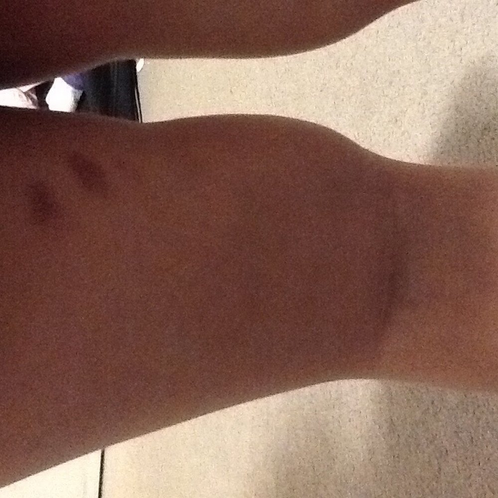Lotsa Tots Childcare Services - BRUISES ON MY DAUGHTER'S LEG FROM THE IRRESPONSIBLE PEOPLE AT THE DAYCARE!!!!!!!!!! - Child Care & Day Care Near Me - Red Deer, Alberta Lotsa Tots Childcare Services - BRUISES ON MY DAUGHTER'S LEG FROM THE IRRESPONSIBLE PEOPLE AT THE DAYCARE!!!!!!!!!! - Child Care & Day Care Near Me - Red Deer, Alberta